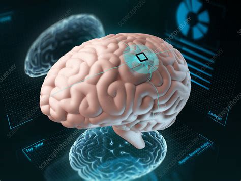 Brain chip implanted in human 